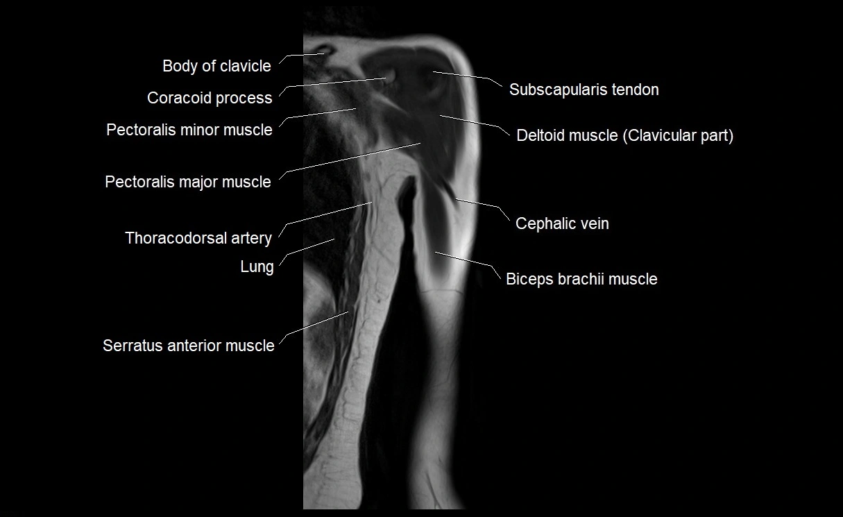 MRI upper arm (humerus ) coronal cross sectional anatomy image 4.webp